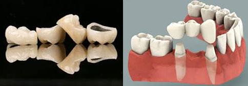 crowns and bridgework-image